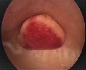 Endometritis